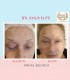 Treatment with BTL Exilis Elite in Iasi - reduces wrinkles, blurs dark circles and increases lip volume