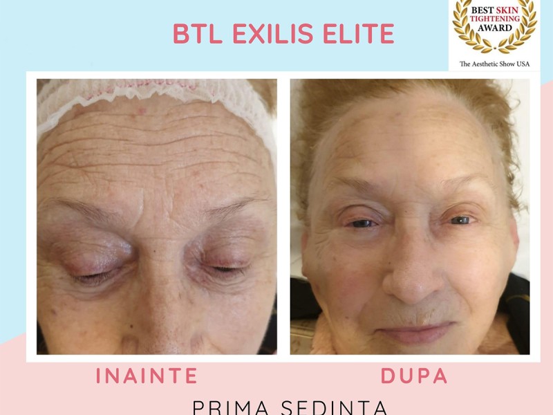 Treatment with BTL Exilis Elite in Iasi - reduces wrinkles, blurs dark circles and increases lip volume