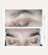 Treatment with BTL Exilis Elite in Iasi - reduces wrinkles, blurs dark circles and increases lip volume