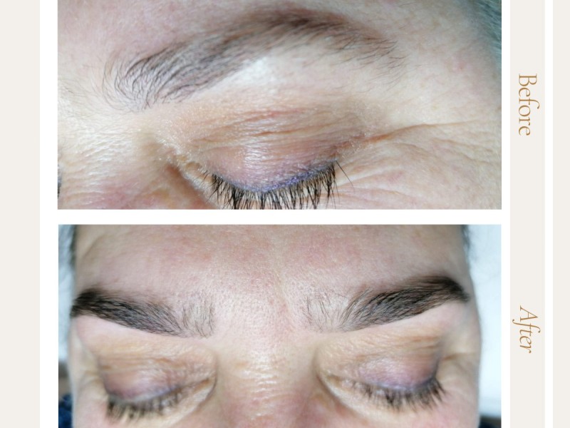 Treatment with BTL Exilis Elite in Iasi - reduces wrinkles, blurs dark circles and increases lip volume