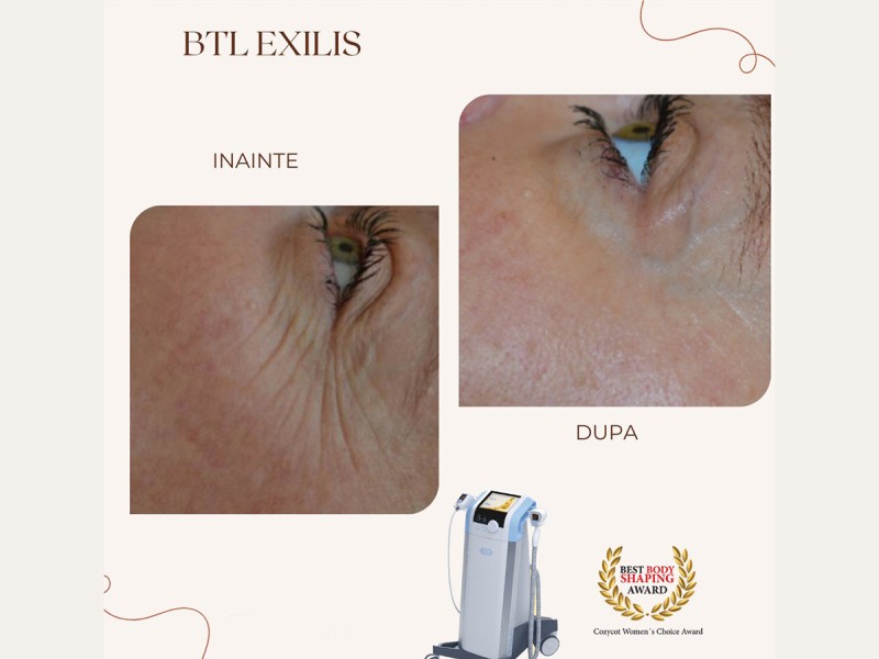 Treatment with BTL Exilis Elite in Iasi - reduces wrinkles, blurs dark circles and increases lip volume