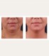 Treatment with BTL Exilis Elite in Iasi - reduces wrinkles, blurs dark circles and increases lip volume