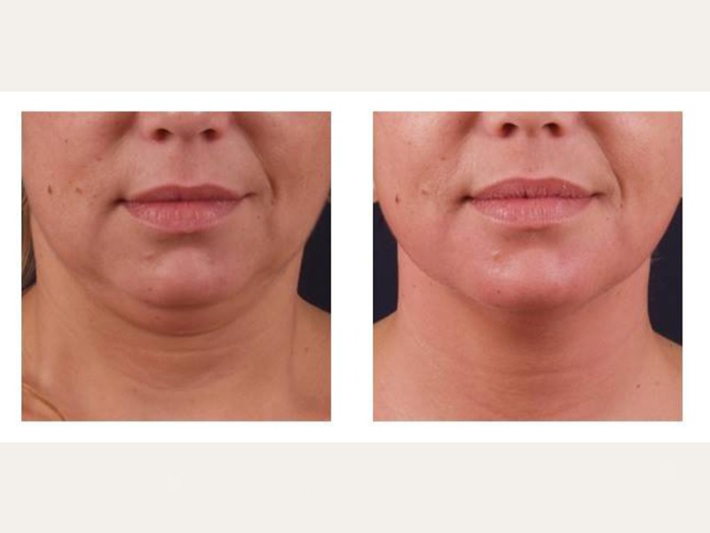 Treatment with BTL Exilis Elite in Iasi - reduces wrinkles, blurs dark circles and increases lip volume