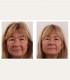Treatment with BTL Exilis Elite in Iasi - reduces wrinkles, blurs dark circles and increases lip volume