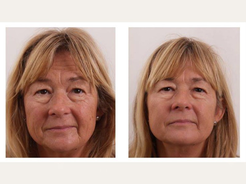 Treatment with BTL Exilis Elite in Iasi - reduces wrinkles, blurs dark circles and increases lip volume