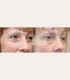 Treatment with BTL Exilis Elite in Iasi - reduces wrinkles, blurs dark circles and increases lip volume