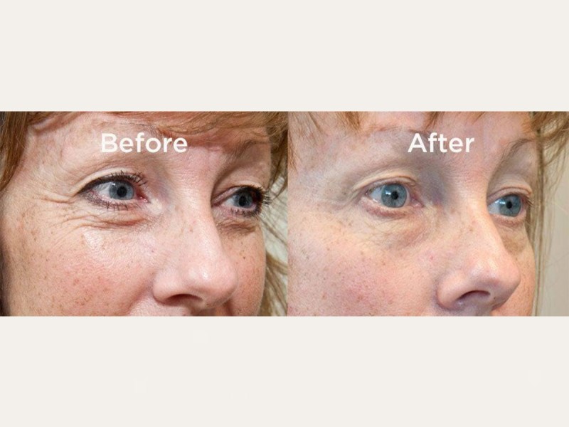 Treatment with BTL Exilis Elite in Iasi - reduces wrinkles, blurs dark circles and increases lip volume